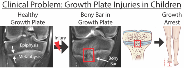 Clinical Problem-Growth Plate Injuries in Children