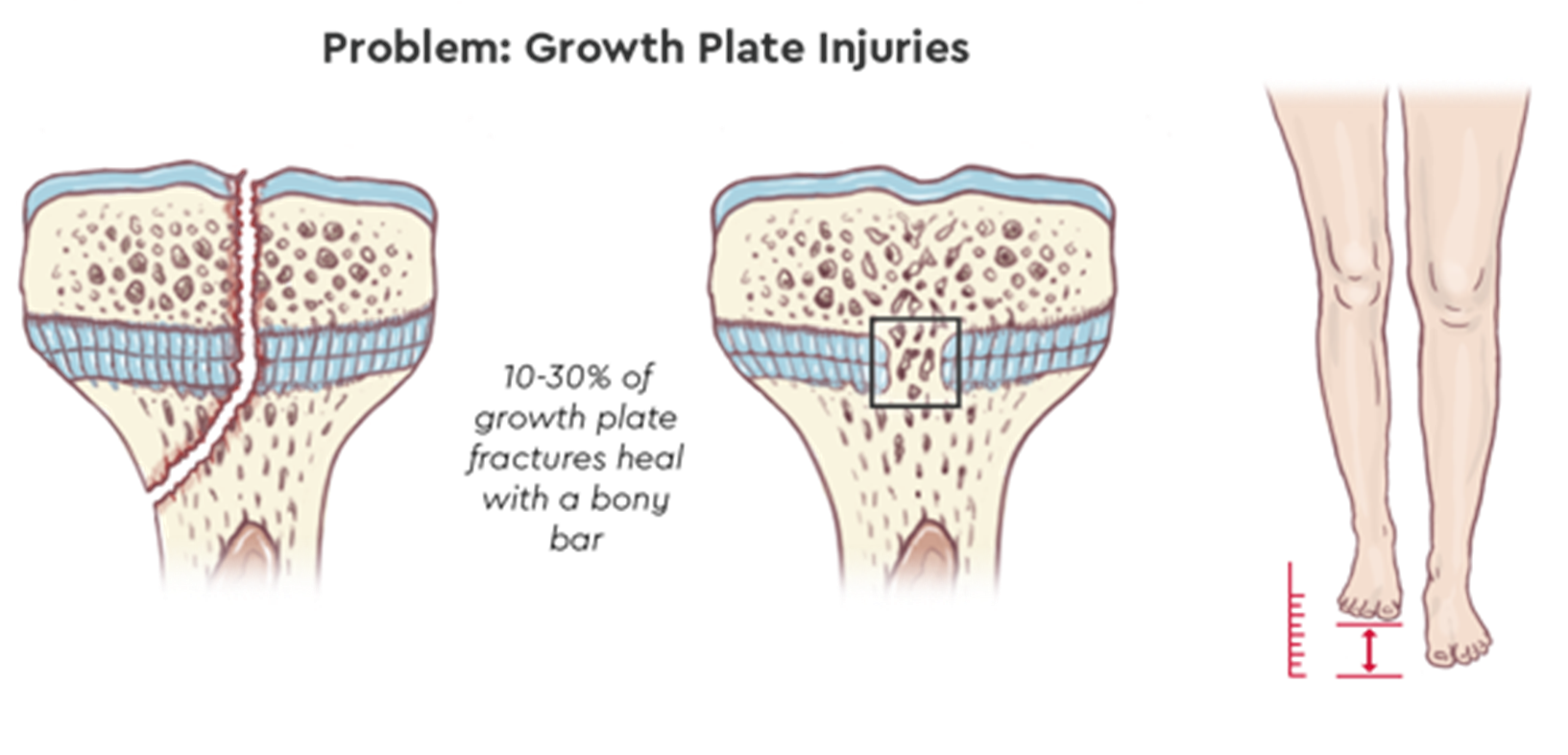 Growth Plate Injuries
