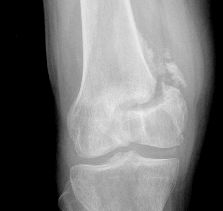 Patient G - Nonunion