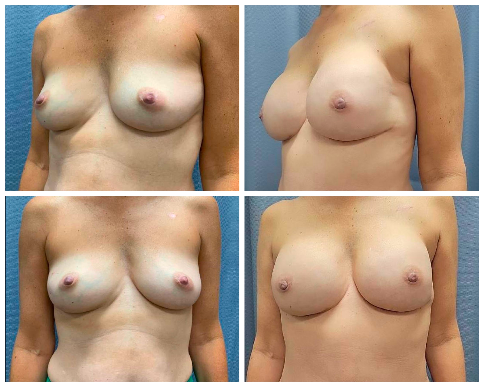 bilateral nipple sparing mastectomy for cancer with implant based reconstruction
