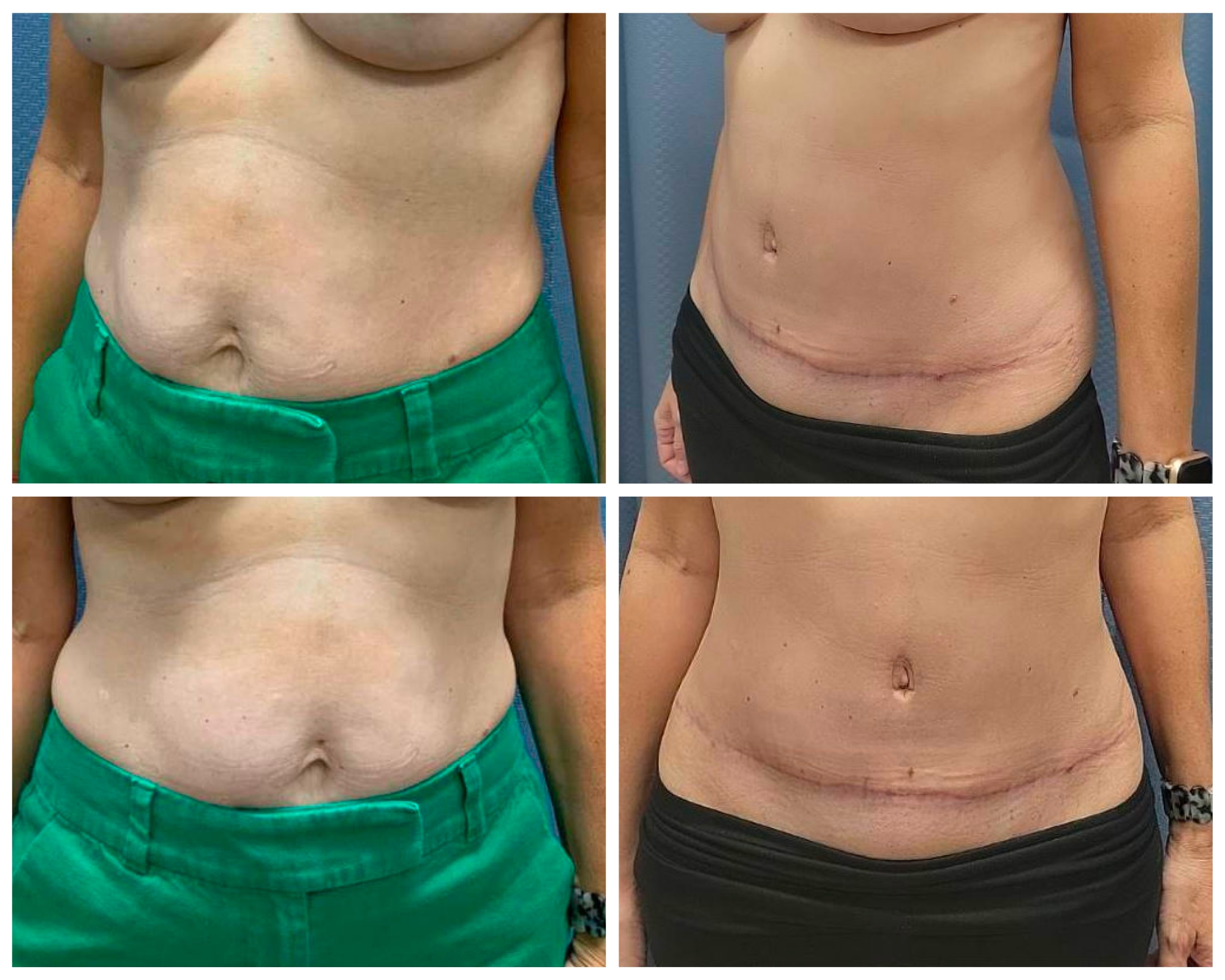 Tummy Tuck with implant based reconstruction