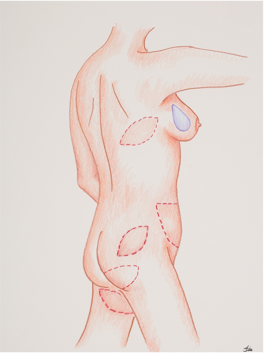 Autologous Tissue Reconstruction