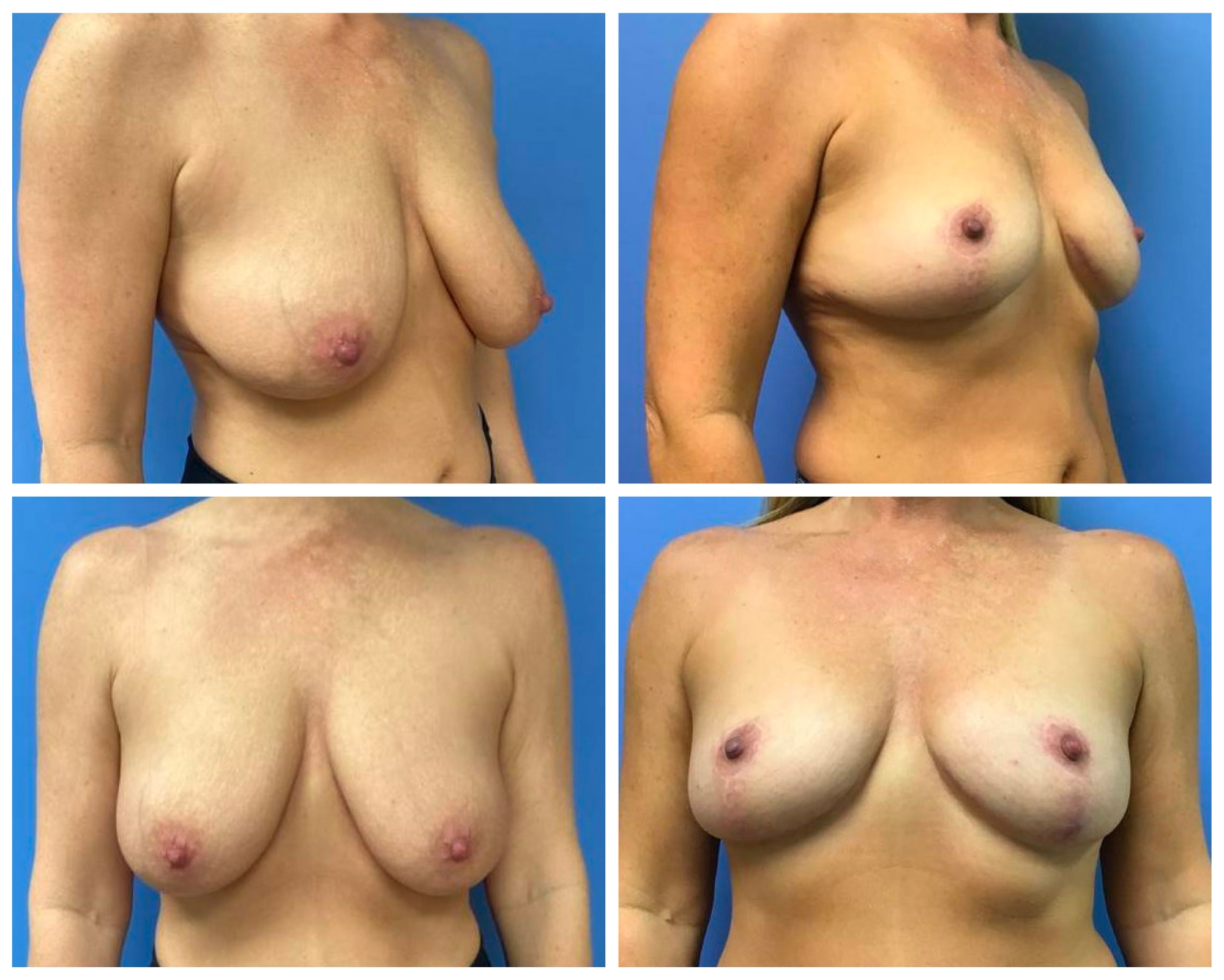 Breast Reduction Before/After in Colorado