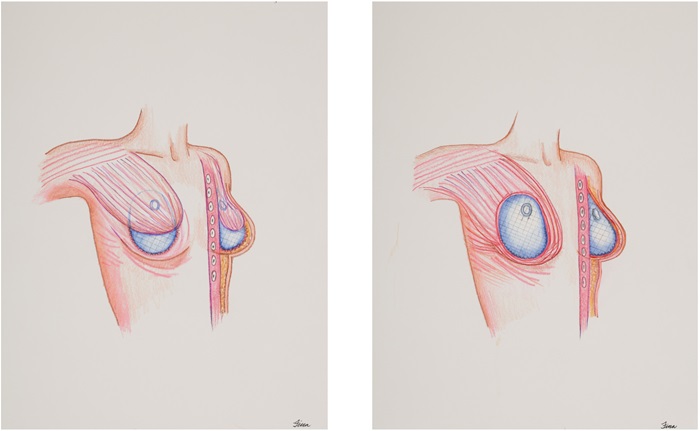 Post-Mastectomy Breast Implant