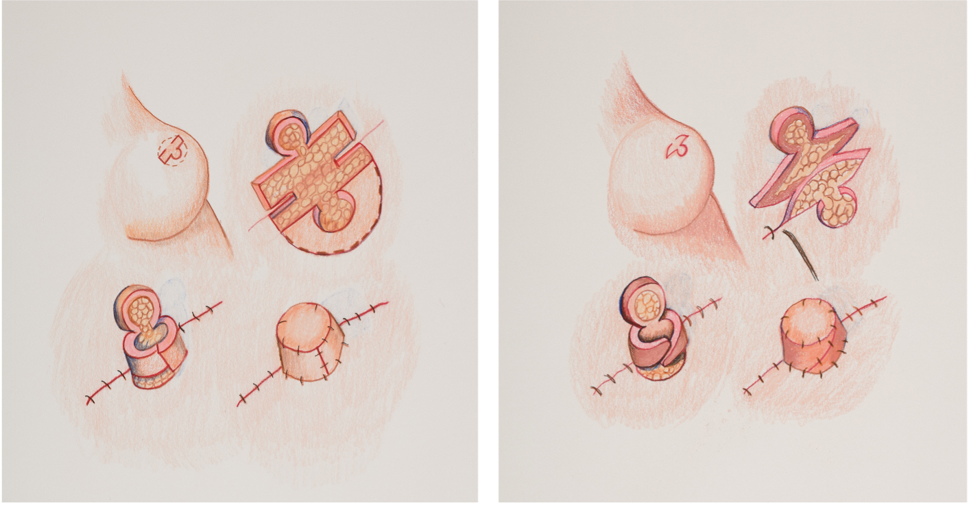 Nipple Reconstruction