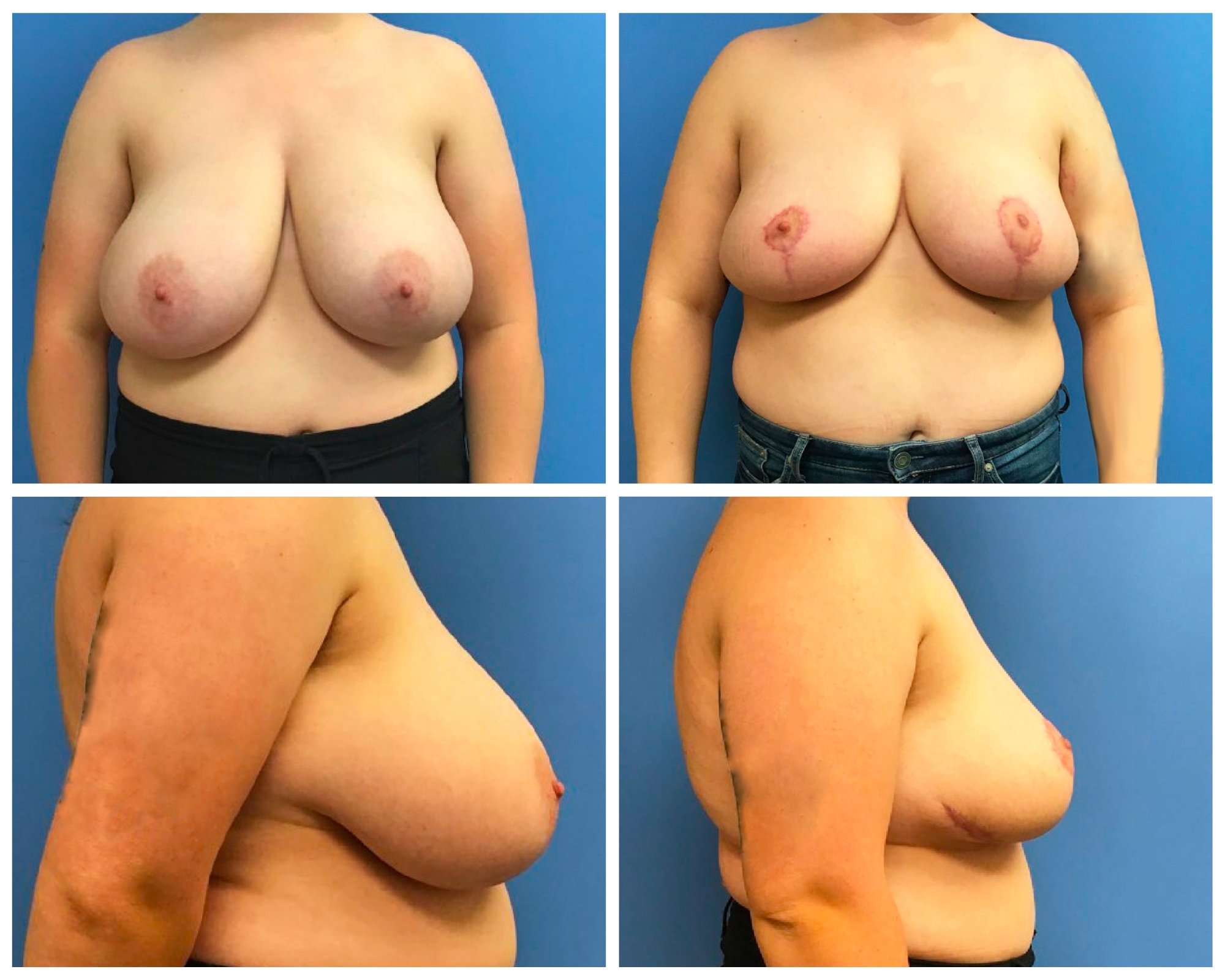 Breast Reduction Before / After Photo University of Colorado