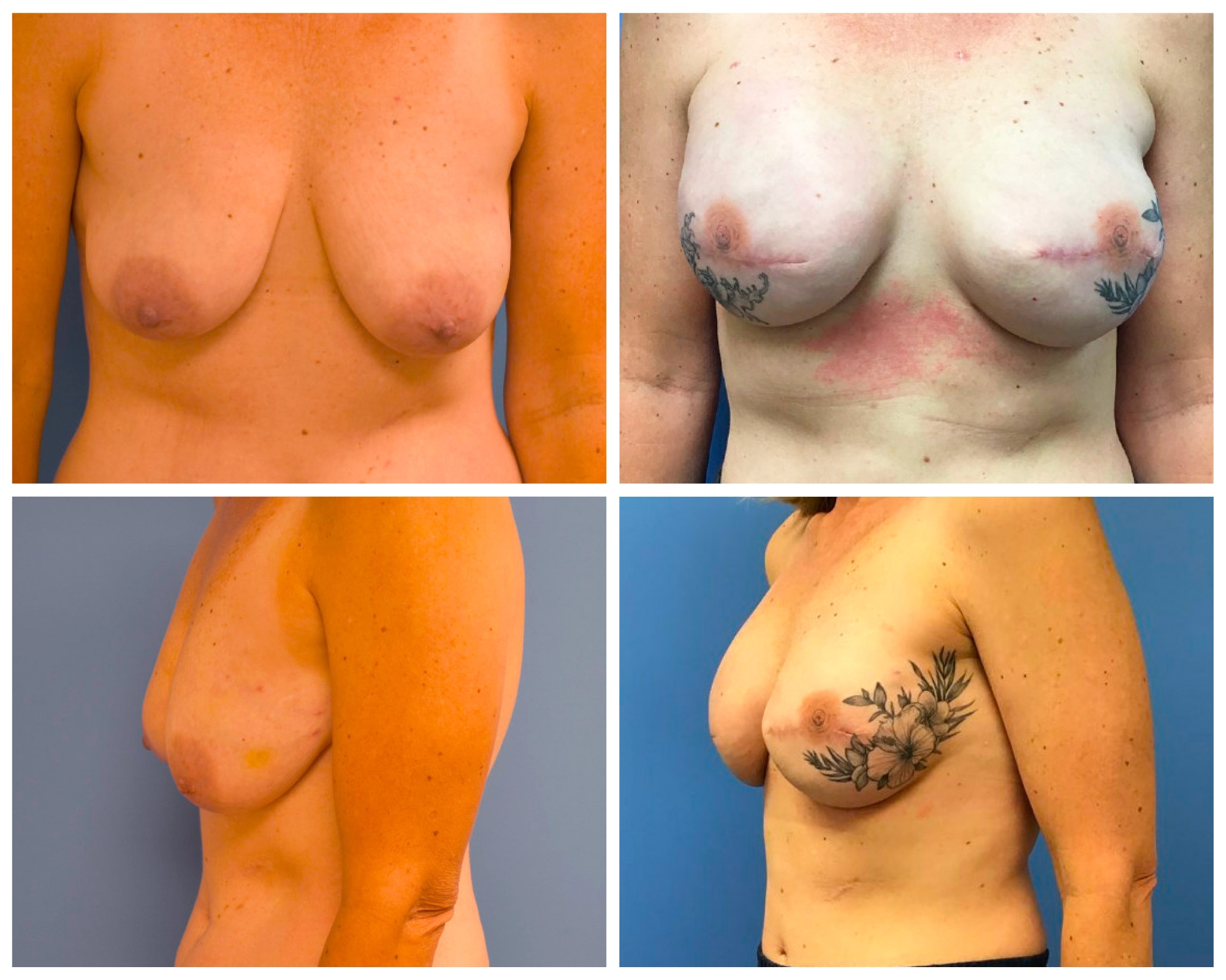 Implant-based breast reconstruction with nipple tattoo after mastectomy