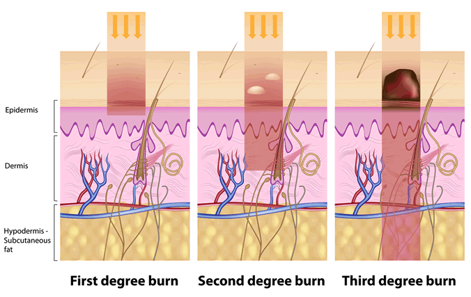 Thermal Burns