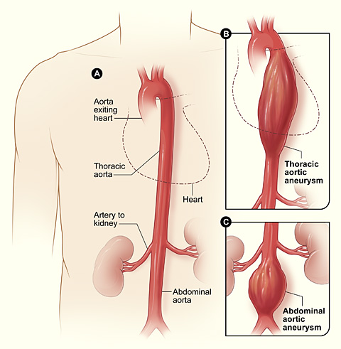 Aortic aneurysm diagram