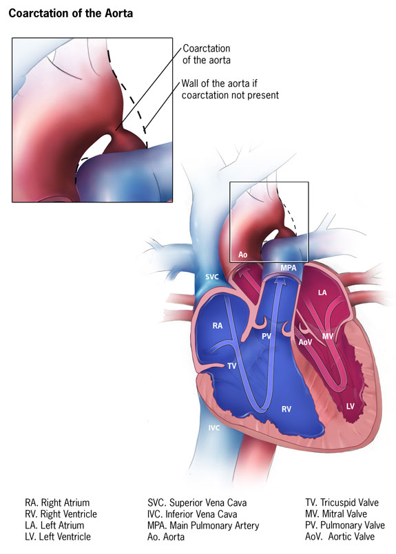 Diagram: Coarctation of the Aorta