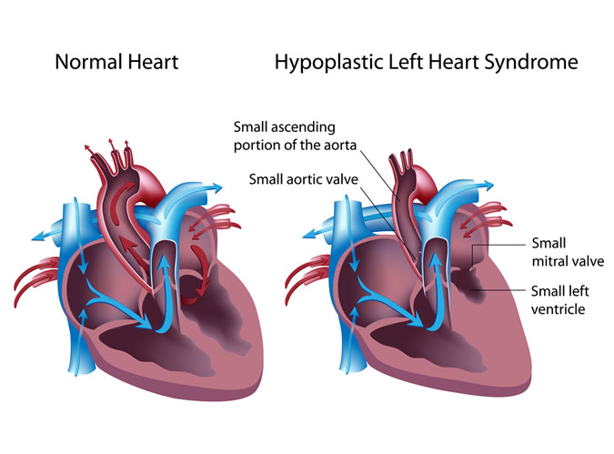 hypoplastic-left-heart-