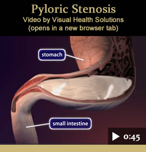 Video: Plyoric Stenosis