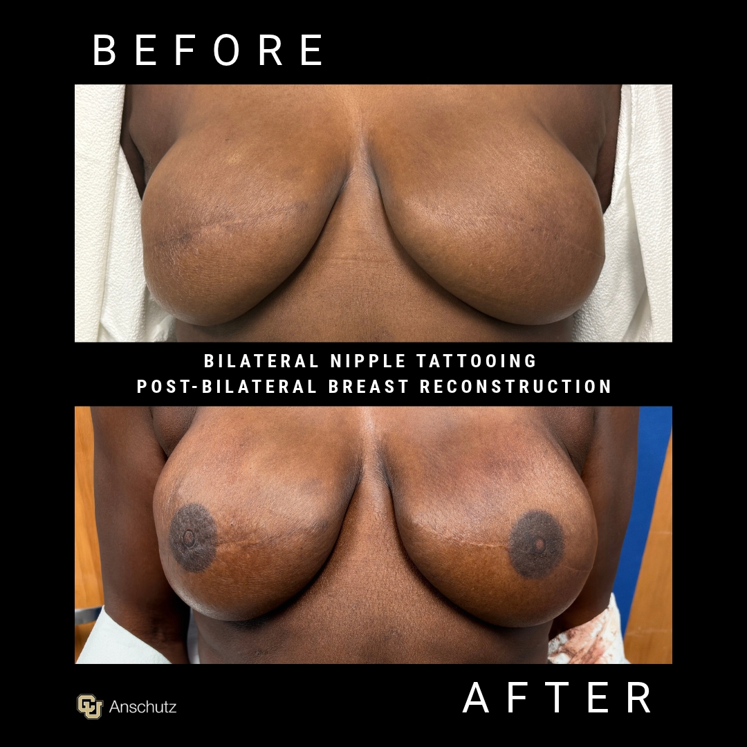 Nipple Tattoo Patient 1