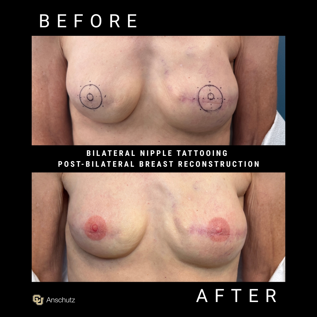 Nipple Tattoo Patient 2