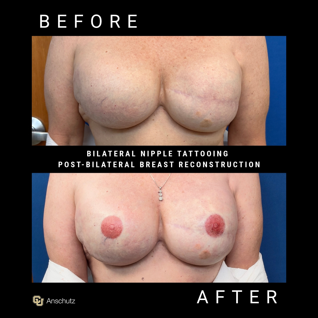 Nipple Tattoo Patient 3