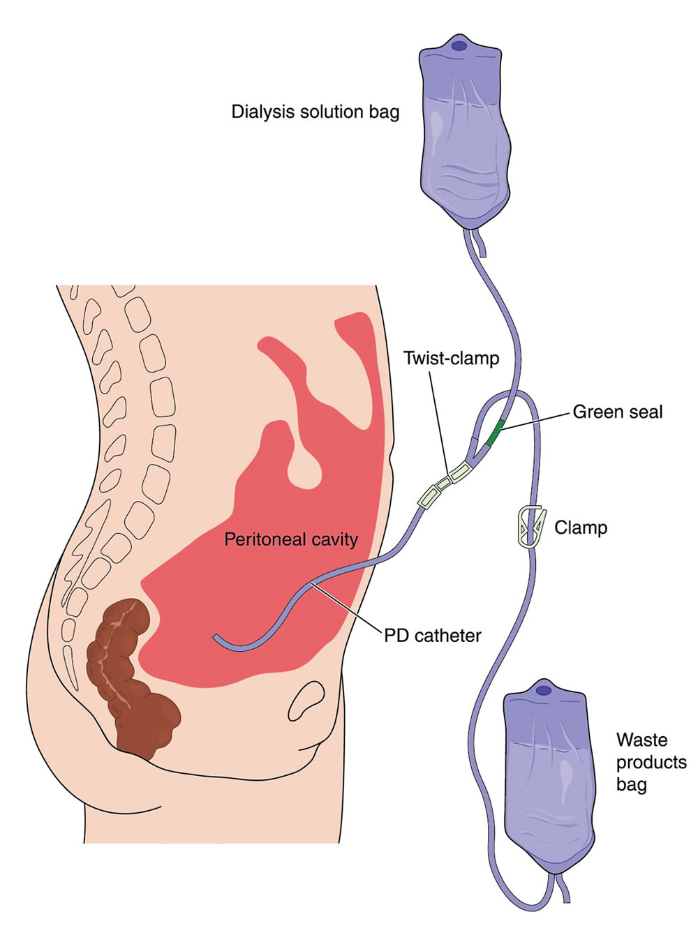 Peritoneal dialysis catheter -- Diagram 1