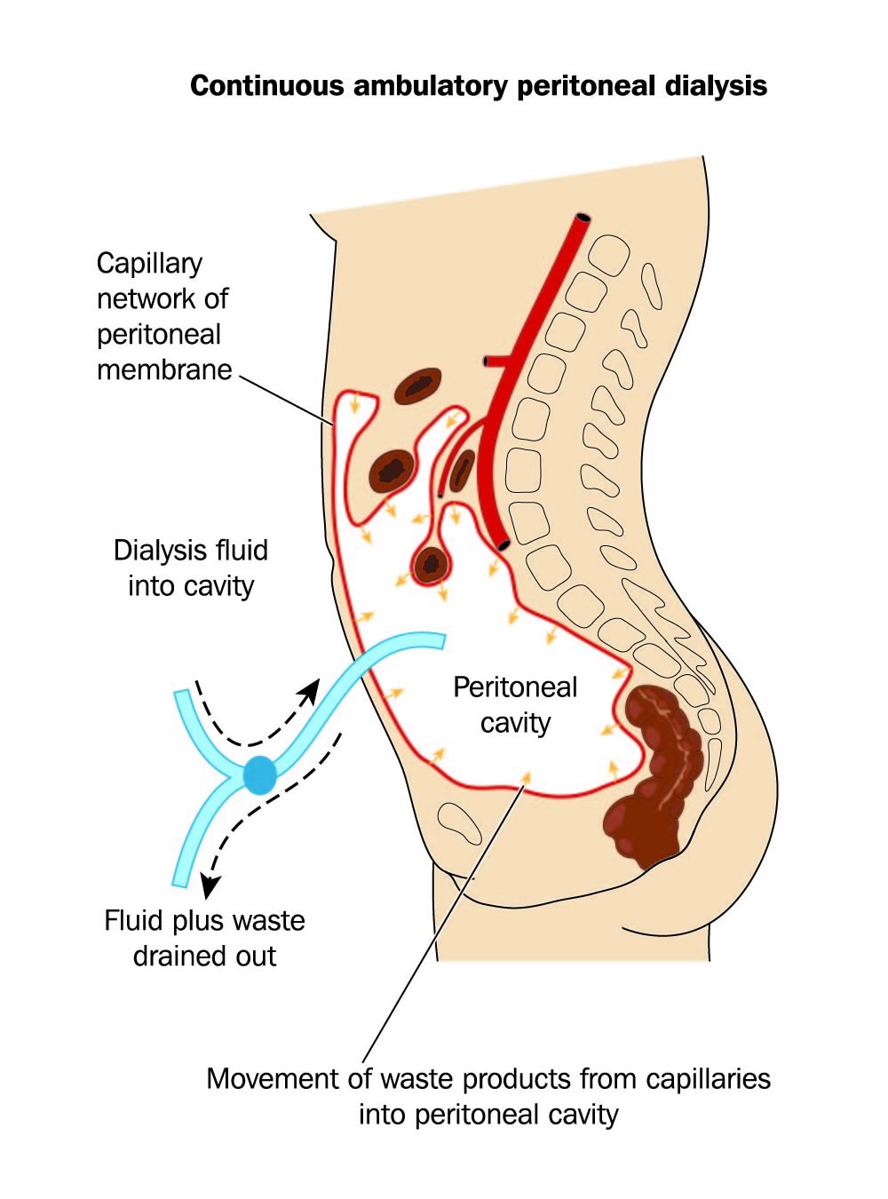 how to flush a peritoneal dialysis catheter