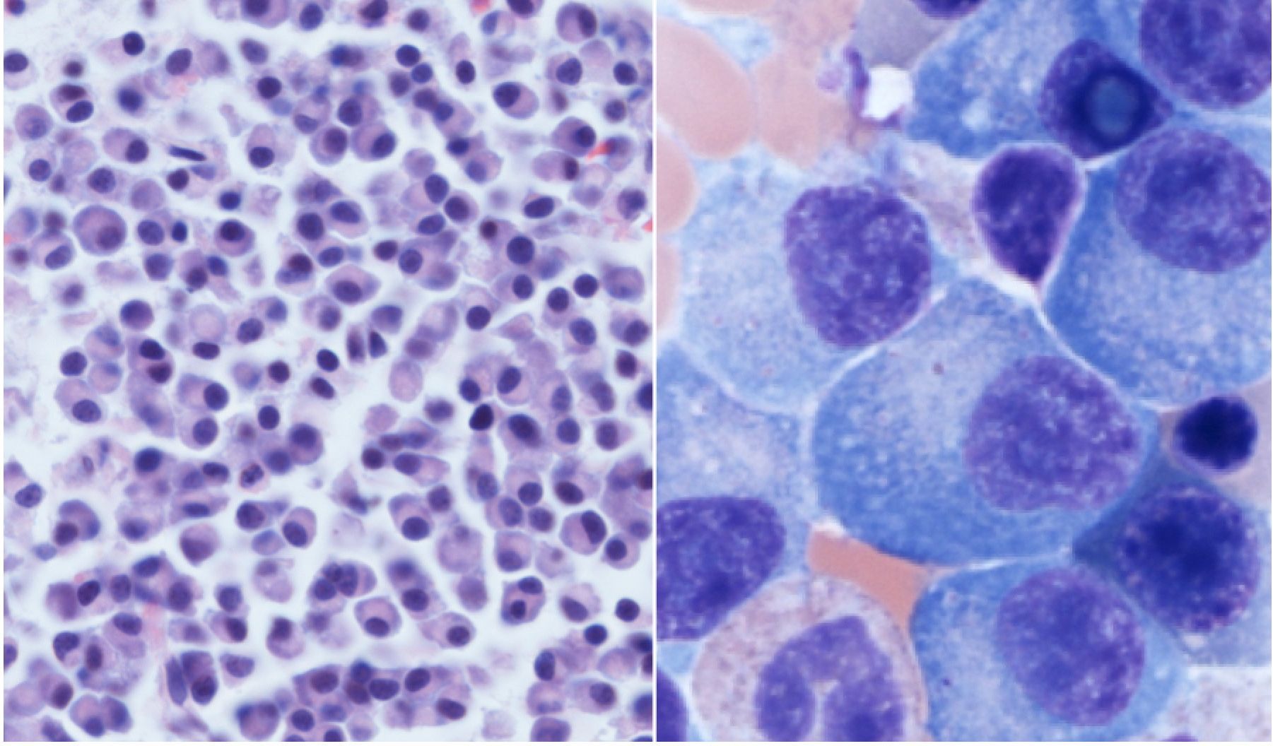 Sherb Myeloma Cell Figure